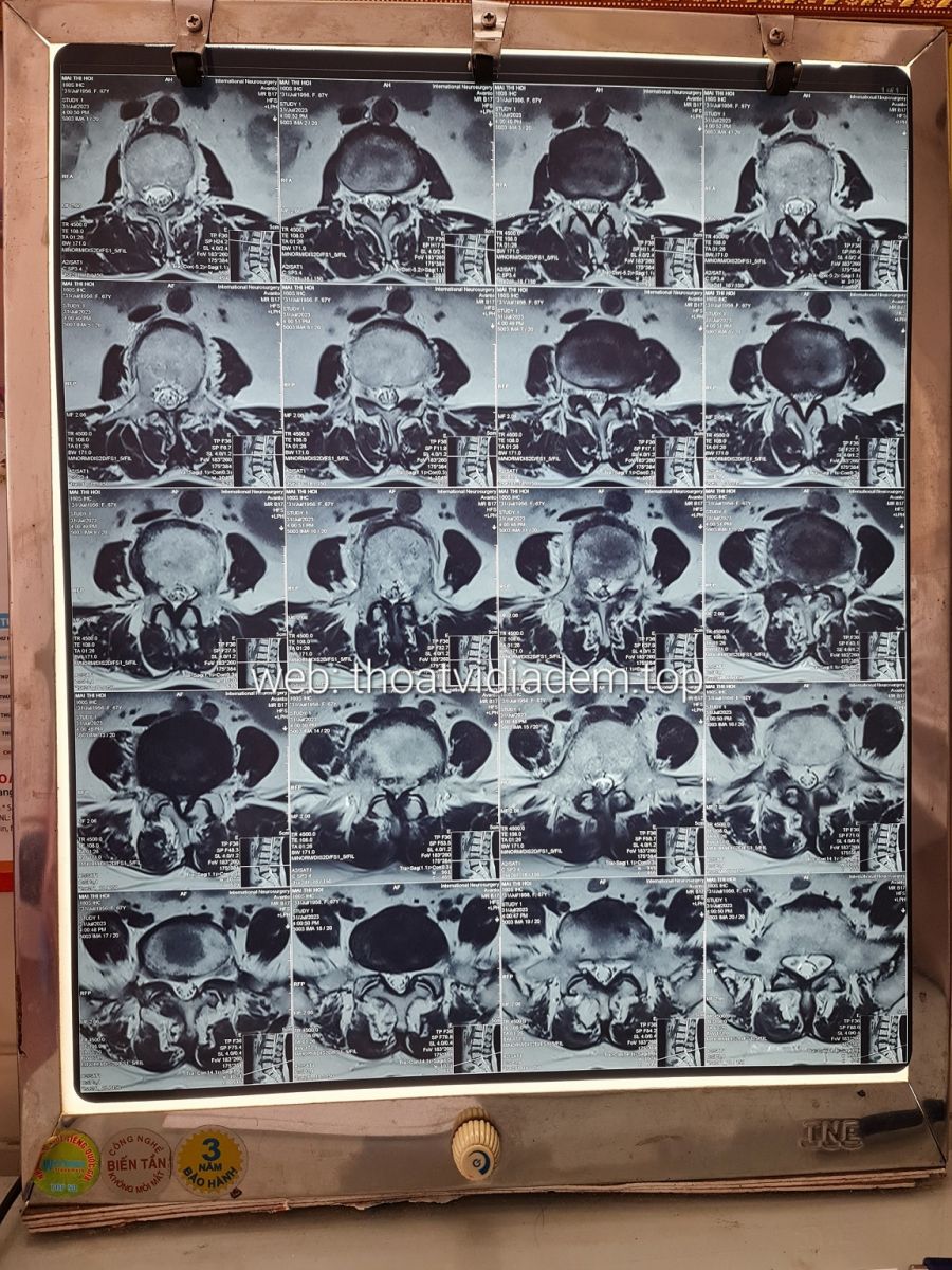 Hình ảnh thoát vị đĩa đệm L4 L5